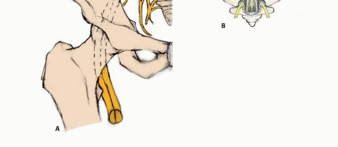 Illustration 3 for Sacral Tumor Surgery: Safeguarding Bowel & Bladder Control