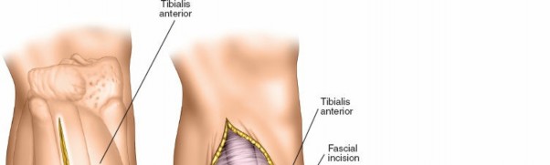 Illustration 108 for Surgical Access: Mastering the Tibia's Surface & Fibula Approaches