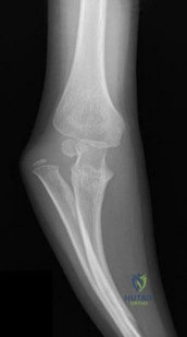 Diabetic Foot Screening & Neuropathy MCQs
