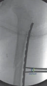 Posterior Tibial Tendon Dysfunction and Adult-Acquired Flatfoot Deformity
