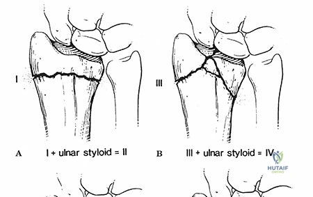Illustration of distal radius fractures - Dr. Mohammed Hutaif