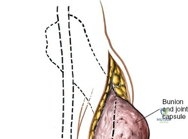 First MTP Joint Dorsal Approaches: Anatomy, Biomechanics & Surgical Principles