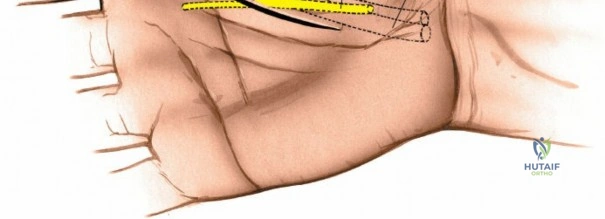 Illustration of drainage of the lateral - Dr. Mohammed Hutaif