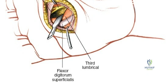 Image illustrating the careful dissection of digital nerves