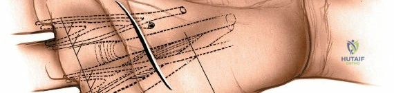 Further illustration of blunt dissection into the deep palmar space