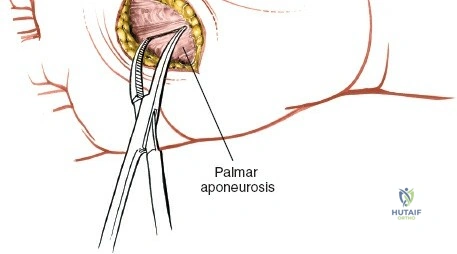 Image of pre-operative imaging for hand infection