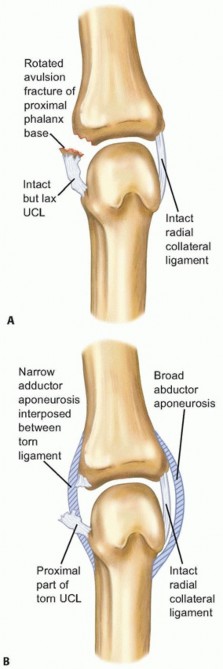 Arthroscopic and Open Primary Repair of Acute Thumb Metacarpophalangeal Joint Radial and Ulnar Collateral Ligament Disruptions
