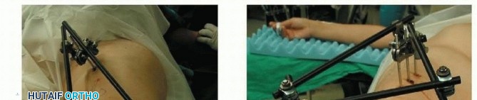 Illustration 38 for Repairing Distal Femur Fractures: Open Reduction & Internal Fixation