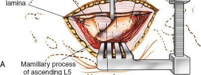 Illustration 10 for Mastering the Spine Posterior Approach: Surgical Essentials