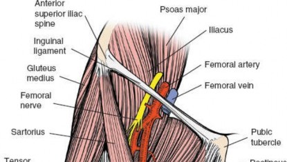 Illustration 97 for Optimal Femoral Approaches: Mastering the Lateral Intermuscular Septum