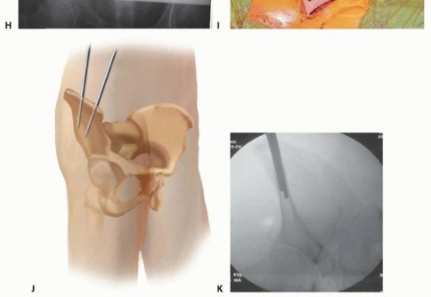 Illustration 19 for Emergency Fixation of the Pelvis: Control Bleeding & Restore Stability