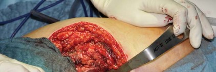 Illustration 60 for Collum Femoris Preserving: Achieve Better Primary Hip Outcomes