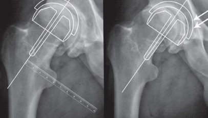 Illustration 6 for Birmingham Hip Resurfacing Designer's Technique for Active Lives