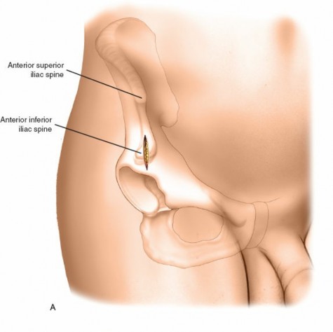 Illustration 26 for Key Approaches for External Fixation: Humerus, Radius, Ulna, Wrist
