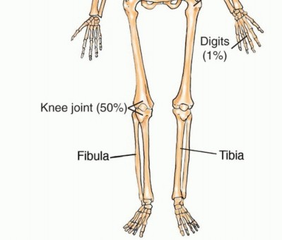 Illustration 33 for Understanding Benign Bone Tumors: Your Complete Preoperative Guide