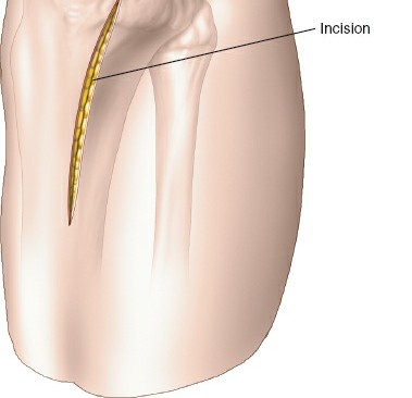 Illustration 18 for Surgical Access: Mastering the Tibia's Surface & Fibula Approaches