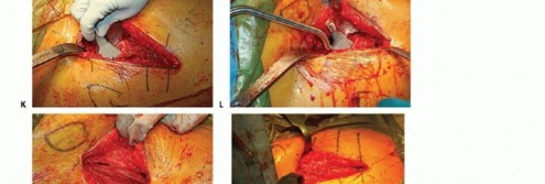 Illustration 20 for Hemiarthroplasty of the Hip: Indications & Types Explained