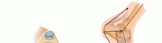 Optimizing Internal Fixation of Sesamoid Fractures