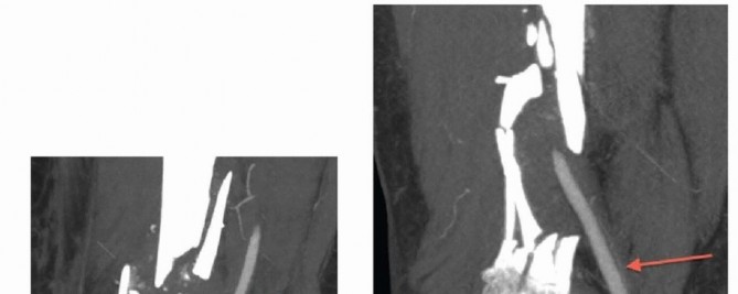 Illustration 7 for Repairing Distal Femur Fractures: Open Reduction & Internal Fixation