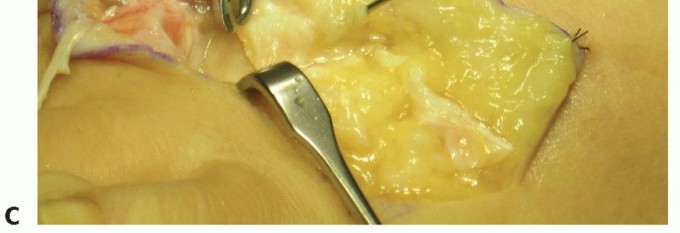 Illustration 18 for Plantar Plate Repair: End Lesser Toe Pain & Instability