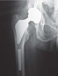 Illustration 40 for The Proxima: Why This Proximally Loading Implant Preserves Bone