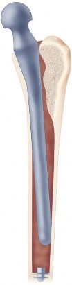 Illustration 4 for Cemented Femoral Stem Figures: Surgical Anatomy & Placement