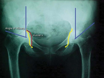 Illustration of replacement for protrusio - Dr. Mohammed Hutaif
