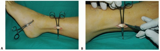 Illustration 42 for Restore Movement: Tendon Transfer for Common Peroneal Nerve Foot Drop