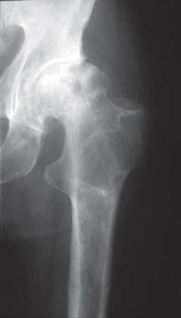 Illustration 44 for S-ROM: Inside the Technique of Modular Implant Design