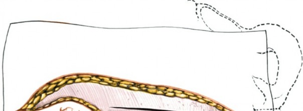 Illustration 9 for Expert Guide: Transperitoneal and Retroperitoneal Lumbar Access