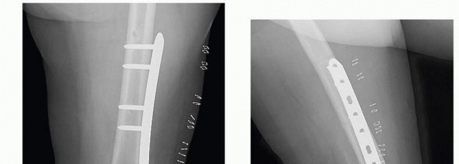 Illustration 33 for Repairing Distal Femur Fractures: Open Reduction & Internal Fixation
