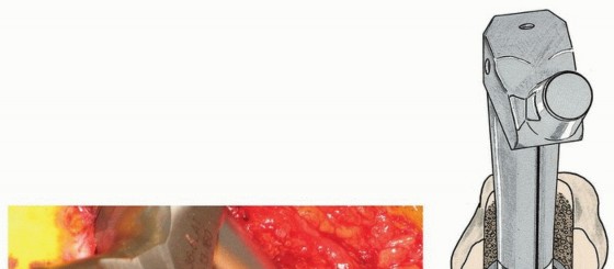 Illustration 25 for Recreate Hip Biomechanics: Modular Stems for Modular Solutions