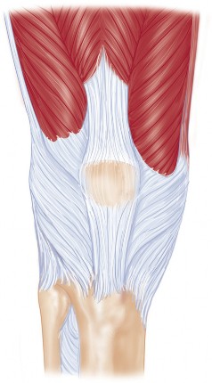 Illustration 8 for Solving Severe Bone Loss: Tantalum for Patellar Reconstruction