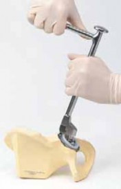 Deciding to Remove Hip Arthroplasty with Well-Fixed Components