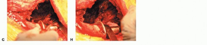 Illustration 8 for Revision Arthroplasty with Acetabular Bone Loss: The Antiprotrusio Cage