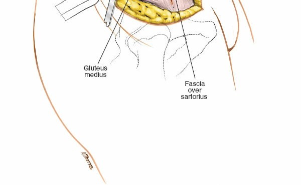 Illustration 18 for Mastering the Posterior Iliac Crest for Bone Graft Harvest