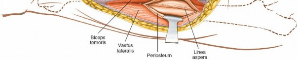 Illustration 43 for Optimal Femoral Approaches: Mastering the Lateral Intermuscular Septum