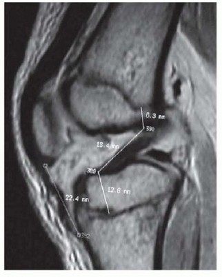 Safe ACL Reconstruction: Intraarticular & Extraarticular in Immature Patients