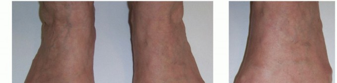 Illustration 2 for Plantar Plate Repair: End Lesser Toe Pain & Instability