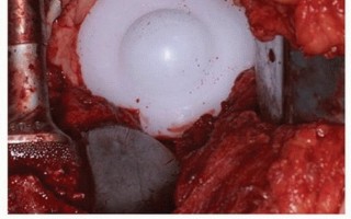 Illustration 17 for Uncemented Acetabular Component: Augments & Cup-Cages for Bone Loss