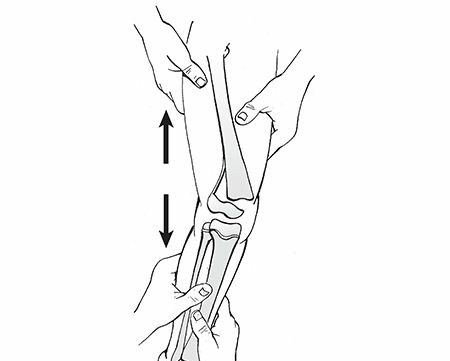 Illustration 13 for Master Pediatric Femoral Shaft & Knee Fractures: Interactive Module