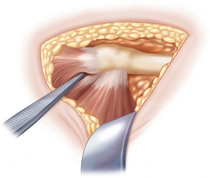 Illustration 4 for Minimally Invasive THA: Navigating Techniques, Benefits & Pitfalls