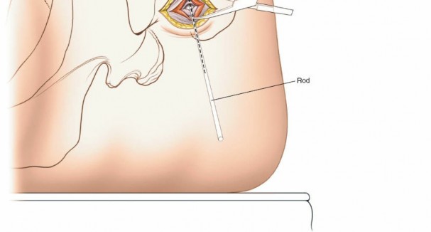 Illustration 76 for Optimal Femoral Approaches: Mastering the Lateral Intermuscular Septum