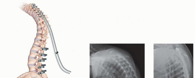 Illustration 32 for Duchenne Muscular Dystrophy: Is Spinal Fusion the Answer?