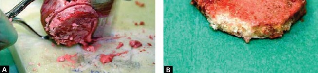 Illustration 38 for Optimizing Acetabular Component Cementation for Superior Outcomes