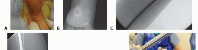 Illustration 29 for Less Pain, More Function: Fassier-Duval Nailing for Osteogenesis Imperfecta