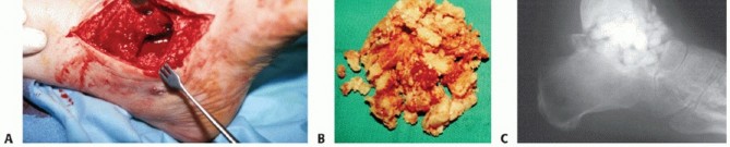 Illustration 9 for Beyond Amputation: Circular Fixation for Infection of the Talus