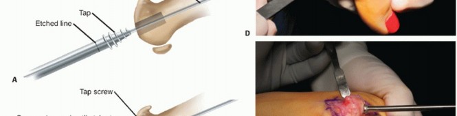 Illustration 23 for End Articular Cartilage Loss: Arthrosurface HemiCAP Resurfacing