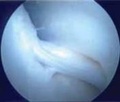 Illustration 29 for Resolving Femoral Head Neck Impingement: Arthroscopic FAI Solutions