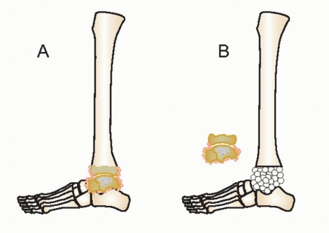 Illustration 20 for Beyond Amputation: Circular Fixation for Infection of the Talus